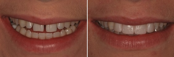לפני ואחרי יישור שיניים מהיר וצמצום רווחים בלסת עליונה בשיניים הקדמיות