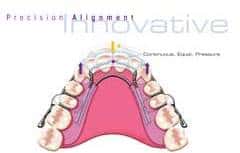 יישור שיניים למבוגרים בשיטת INMAN