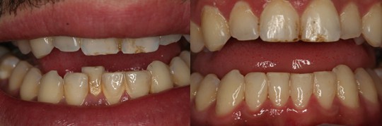 הכנסת שן קדמית בלסת תחתונה על ידי יישור בשיטת INMAN תוך 13 שבועות