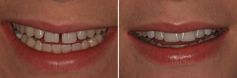 לפני ואחרי יישור שיניים מהיר וציפויים אסתטיים