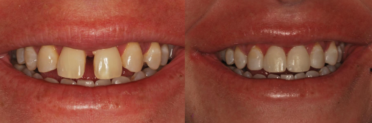 לפני ואחרי יישור שיניים מהיר והקטנת רווחים אצל מטופל
