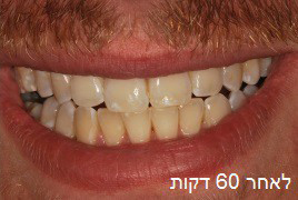אחרי הלבנת שיניים