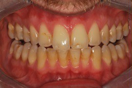 לפני הלבנת שיניים