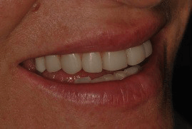 לפני ציפוי אסתטי לשיניים