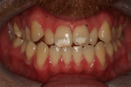 לפני הלבנת שיניים