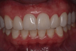אחרי ציפוי אסתטי לשיניים