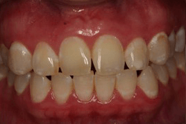לפני ציפוי אסתטי לשיניים
