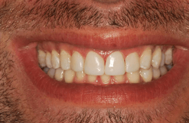 אחרי הלבנת שיניים