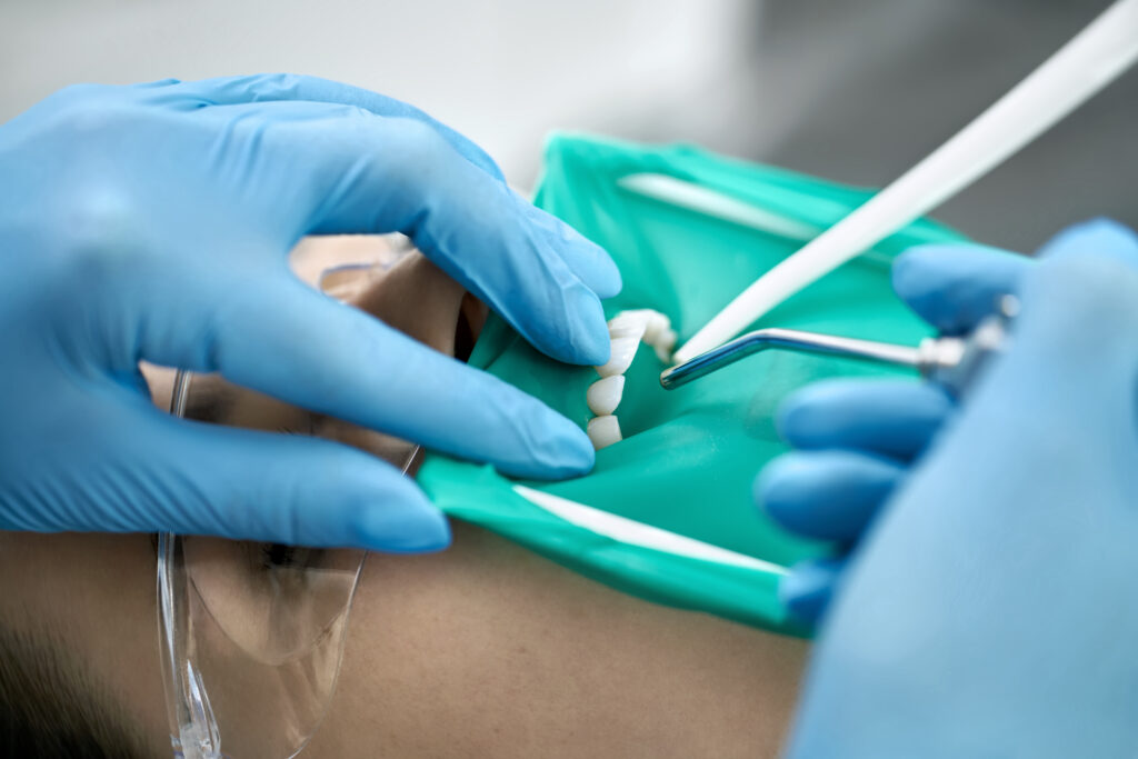 המדריך המלא למי ששוקל ציפוי שיניים