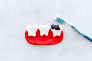 הסרת כתמים בשיניים